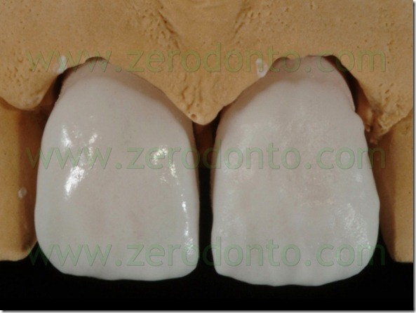 90 stratificazione ceramica massa dentina faccette