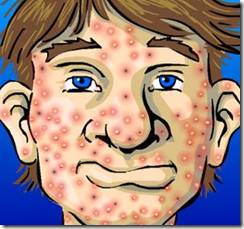 acne1 acne1