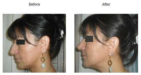 Before And After 5s. Corrector Before and After