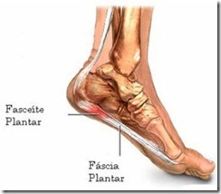 Fascite-Plantar Fascite-Plantar