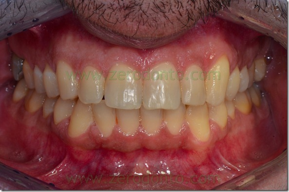 24 overbite