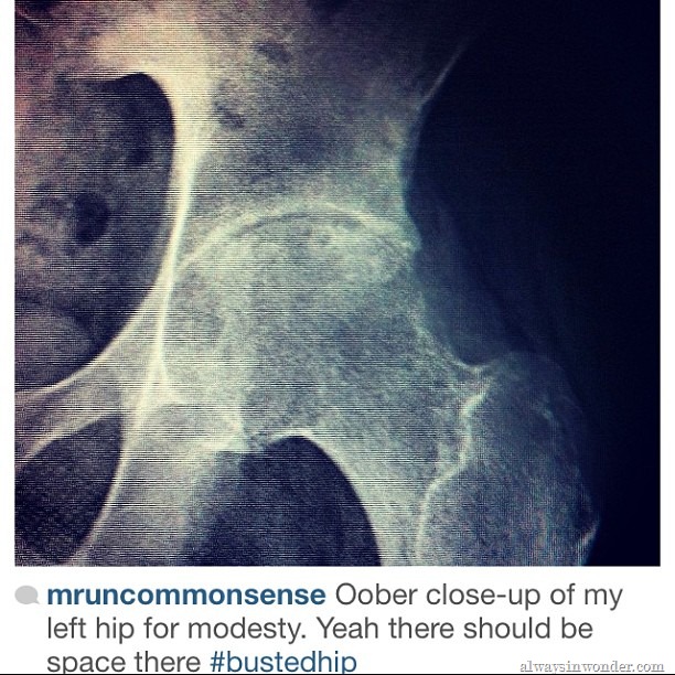 [hip%2520x-ray%255B5%255D.jpg]