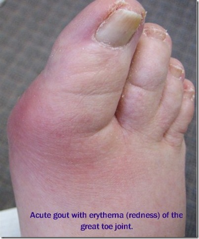 gout_medicalshow gout_medicalshow