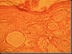 Teratoma-- high resolution histology slide tsnaps Teratoma-- high resolution histology slide tsnaps