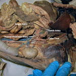 splenic_artery_L.JPG