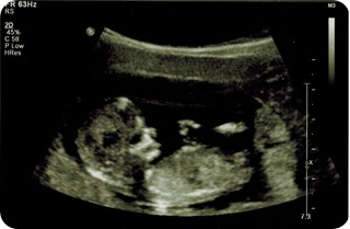 Ultrasound 12 week 3rd image