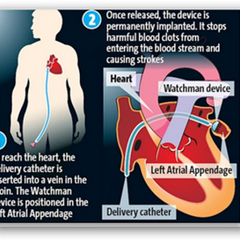 Just Approved by FDA, The Watchman Implanted In Two Patients in Southern California, Will Make Life Normal For Many…