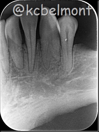canino com 2 raízes periapical canino com 2 raízes periapical