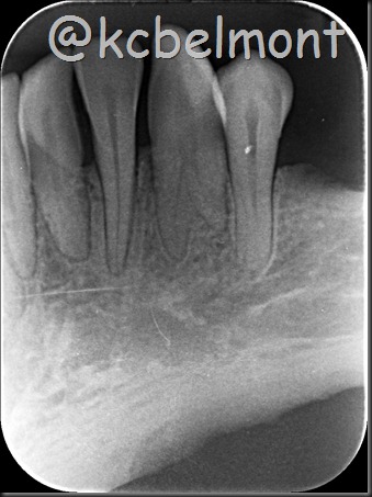 canino com 2 raízes periapical