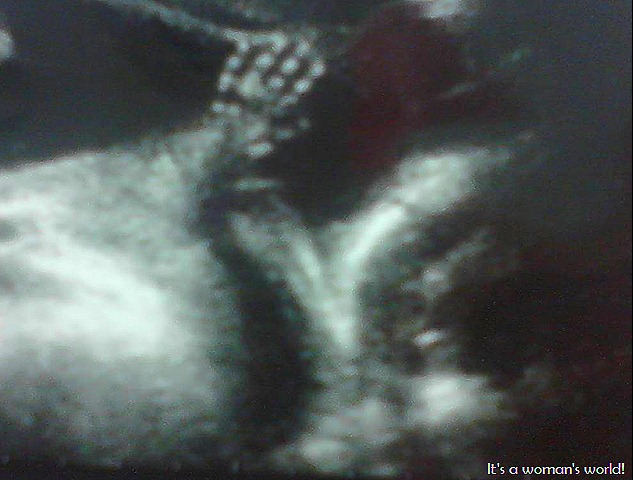 [Amber%2527s%2520sonogram%255B8%255D.jpg]