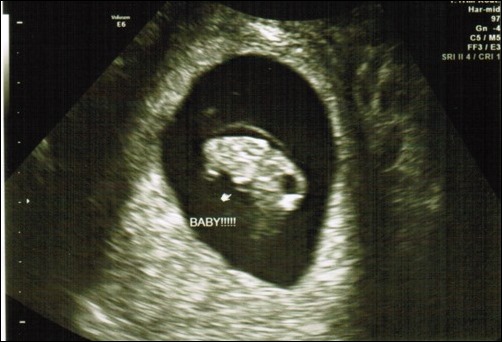 8 week ultrasound