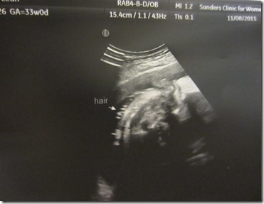 Zoey Nola 33 Week Sonogram3