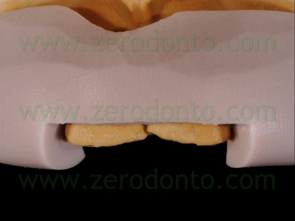 [40-faccette-indice-silicone-incisale%255B1%255D.jpg]