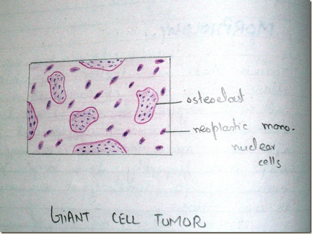 giant cell tumor histopathology diagram