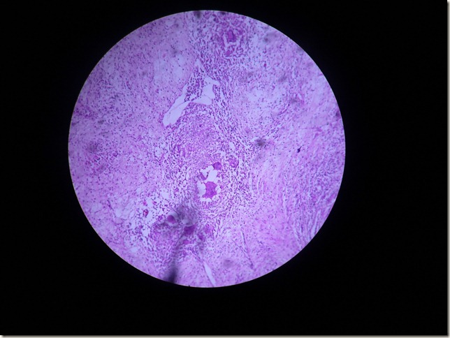 tuberculous granuloma