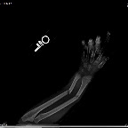 Top view of her arm. Easy to see the clean breaks.