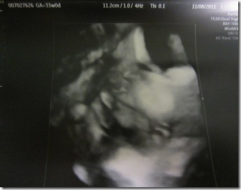 Zoey Nola 33 Week Sonogram4