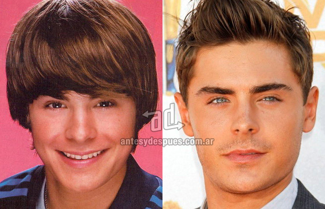 La nueva nariz operada de Zac Efron