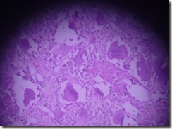 giant cel tumour histopathology slide