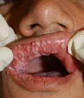 vph-boca.JPG