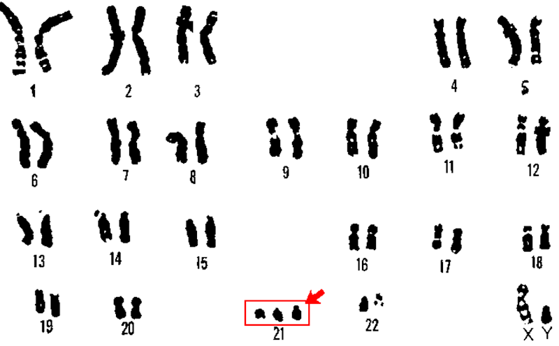 down syndrome karyotype down syndrome karyotype