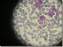 macrocytic anemia histopathology slide