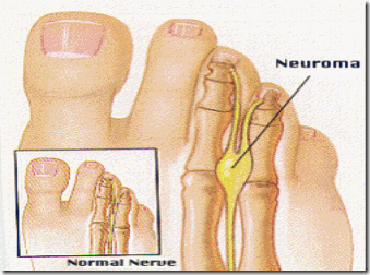 lens1608131_1227297525Neuroma lens1608131_1227297525Neuroma