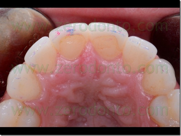 124 controllo occlusione veneers