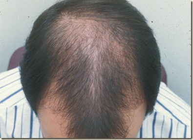 Los champúes hormónicos de la caída de los cabello