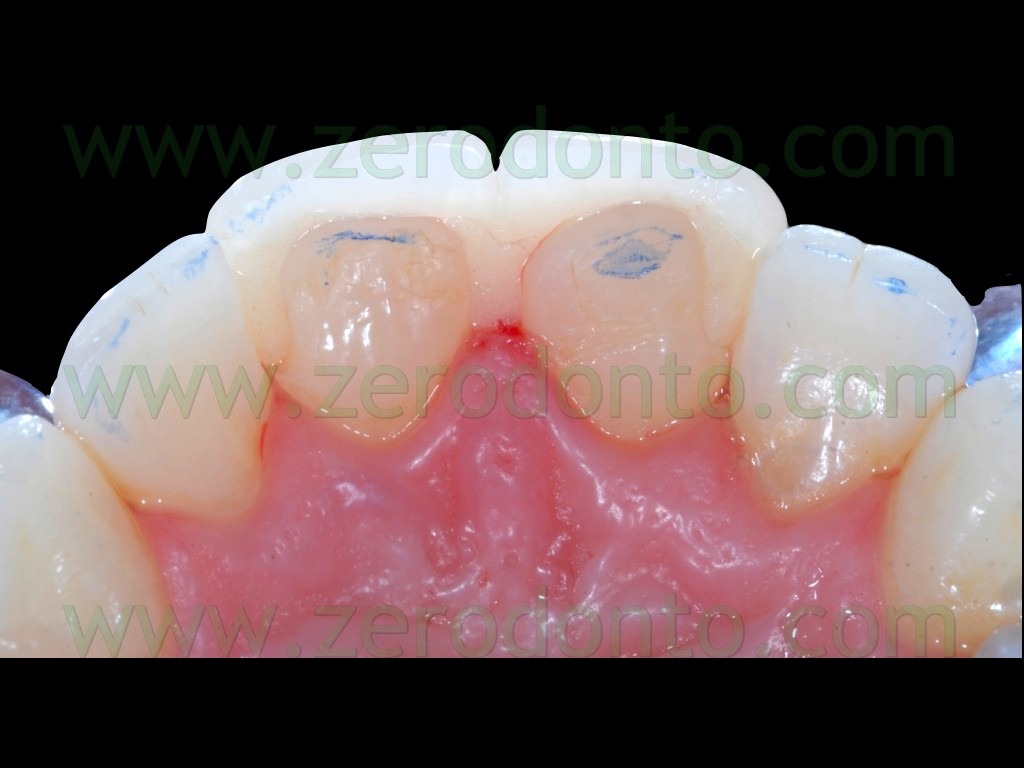[82-preparazione-butt-joint-faccette3.jpg]