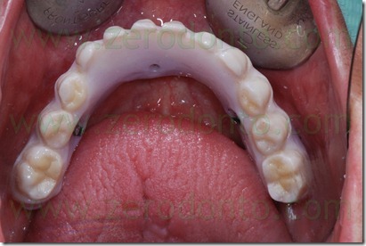 zirconia