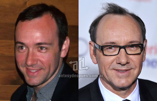 La caida del pelo de Kevin Spacey