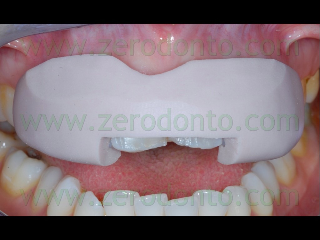 [51-tecnica-preparazione-veneers3.jpg]