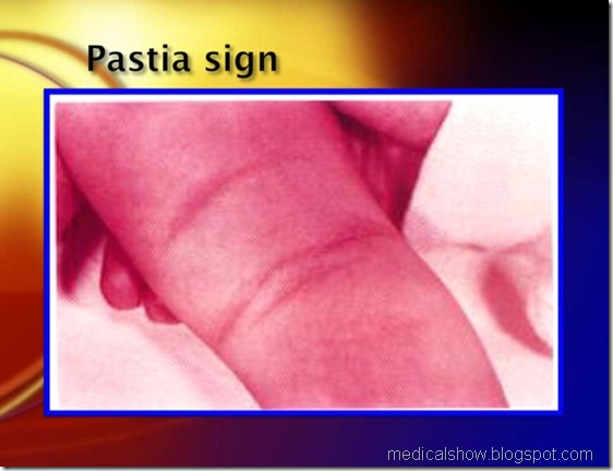  pastia sign