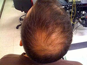 scalp-inflammation-hair-loss