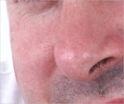 Removing acne in Photoshop Removing-acne-in-Photoshop