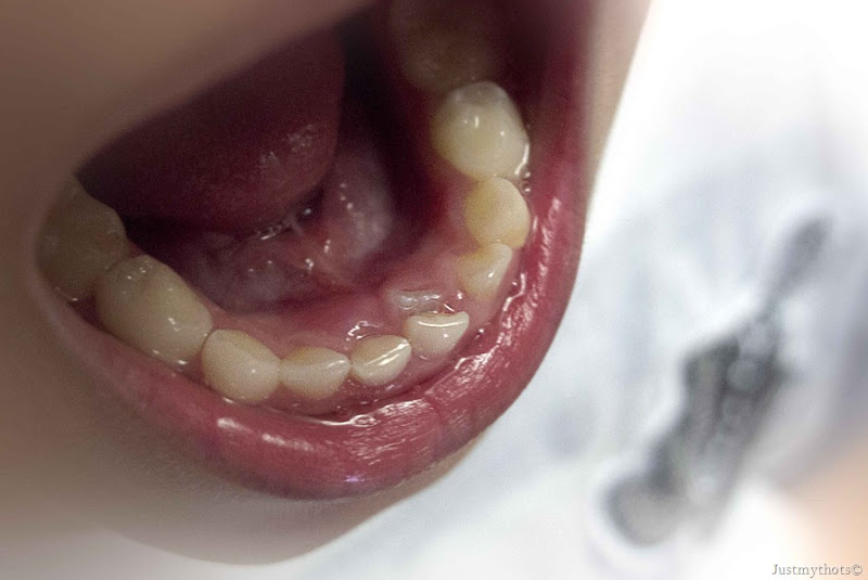 Tooth