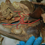 splenic_artery_traced_L.JPG
