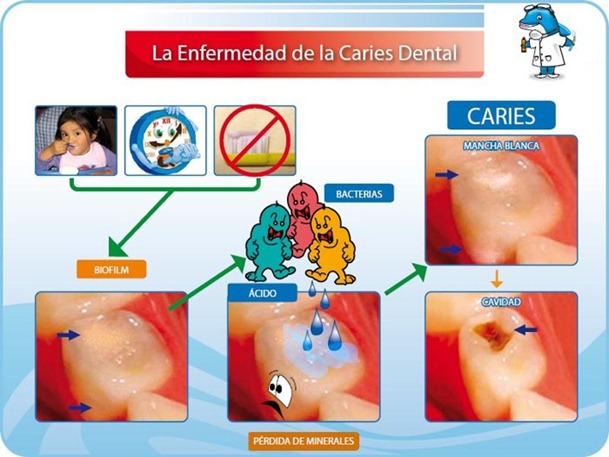 Caries Dental