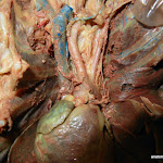 pulmonary_trunk.JPG