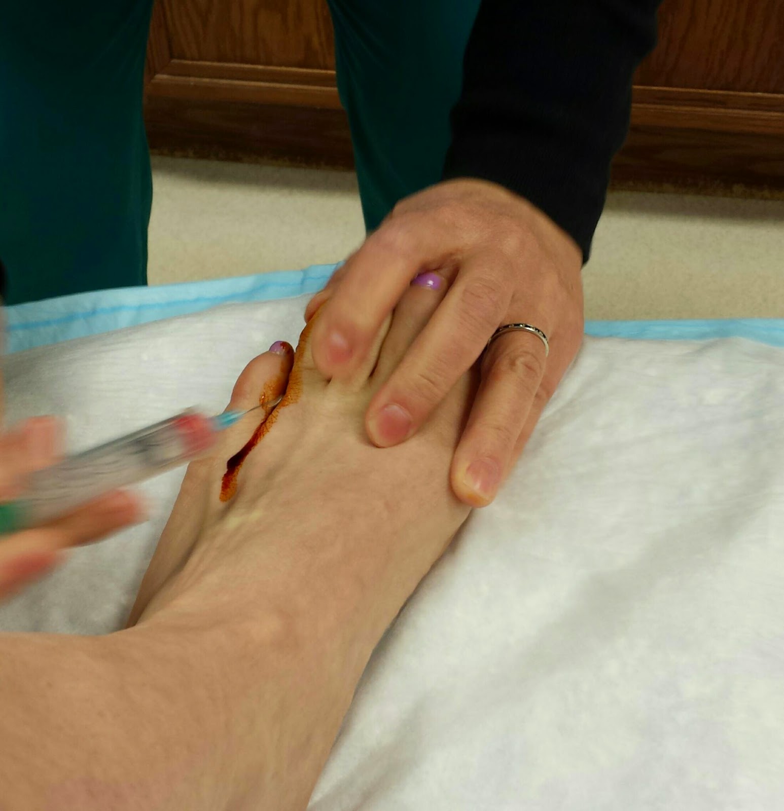 biopsy toe foot super complete