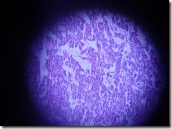 follicular adenoma thyroid histopathology slide photograph
