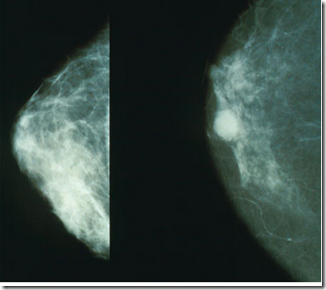 Ciri ciri kanker payudara