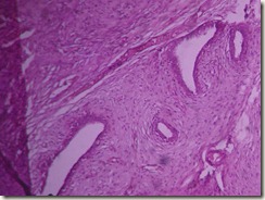 fibroadenoma breast histopathology slide