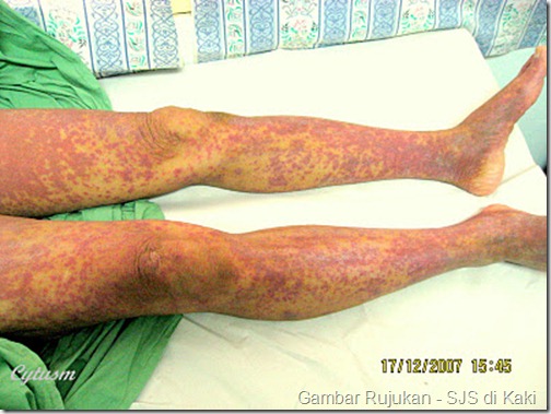 Steven Johnson Sindrome_Adverse Drugs Reaction _Leg