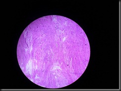 leiomyoma high resolution histology slide tsnaps leiomyoma high resolution histology slide tsnaps