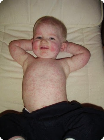 fifth-disease-800x800 fifth-disease-800x800