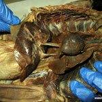 esophagus_vena.JPG