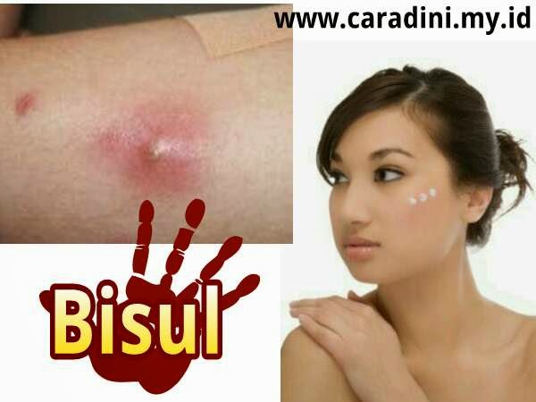 Obat Bisul Obat Bisul