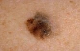 [melanoma%255B5%255D.jpg]